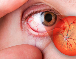 Retinopatia Diabética: como saber se eu tenho? Como tratar?